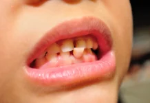 Dent qui bouge : remèdes naturels dent qui bouge remède naturel