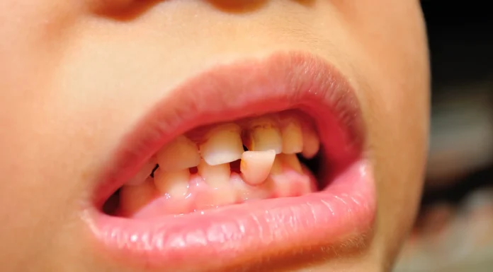 Dent qui bouge : remèdes naturels dent qui bouge remède naturel