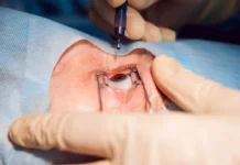 Chirurgie réfractive avec le Dr Chantal Bensoussan Chirurgie réfractive Dr Chantal Bensoussan