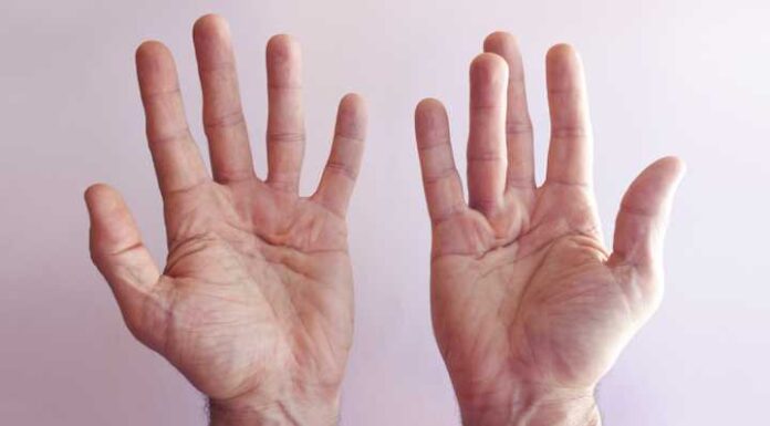 Maladie de Dupuytren : tout savoir à propos maladie de Dupuytren