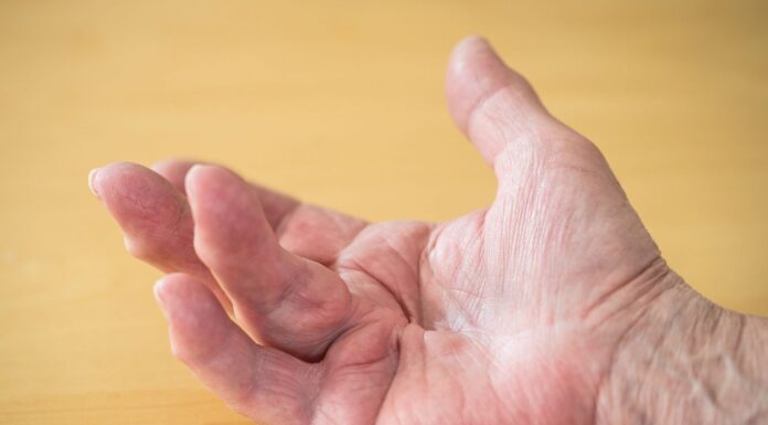 Maladie de Dupuytren : Définition, Symptômes, Causes et Traitements Maladie de Dupuytren